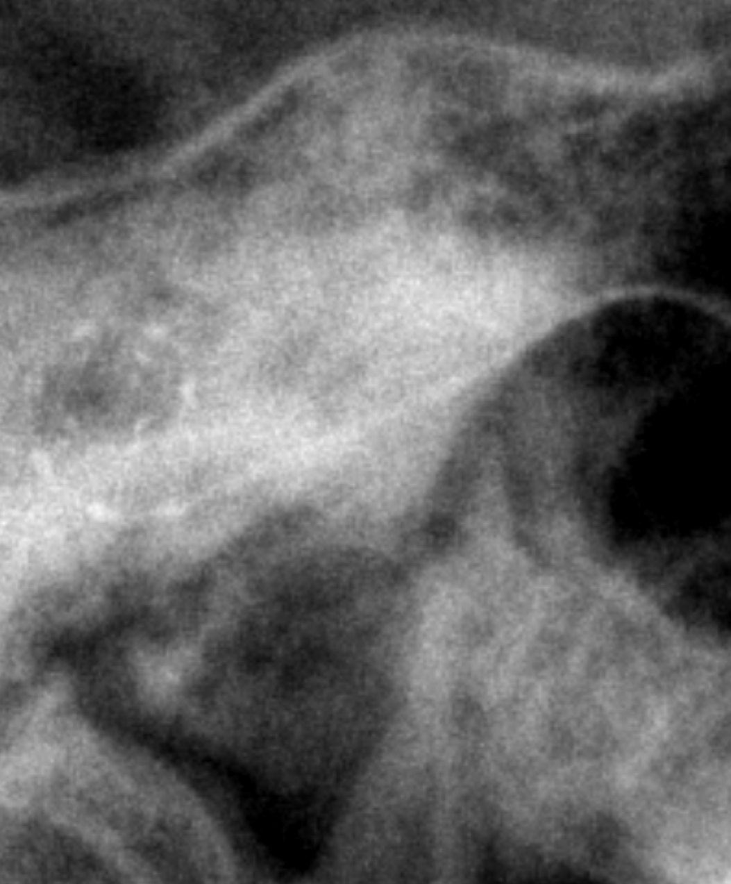 Post-Op CT Scan